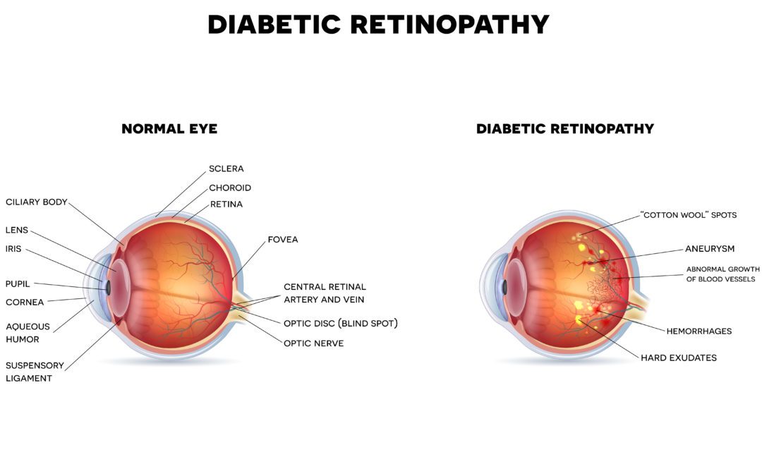6 Out of 10 People with Diabetes Skip a Sight-Saving Exam