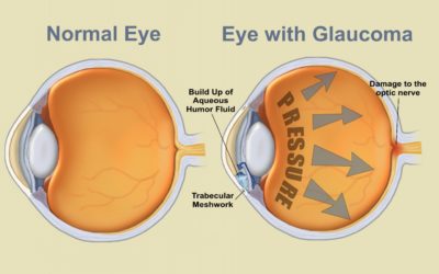Glaucoma is a very misunderstood disease